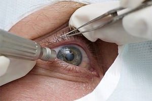 Лечение тромбоза центральной вены сетчатки глаза