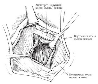Суть операции Иваниссевича при варикоцеле, послеоперационный период