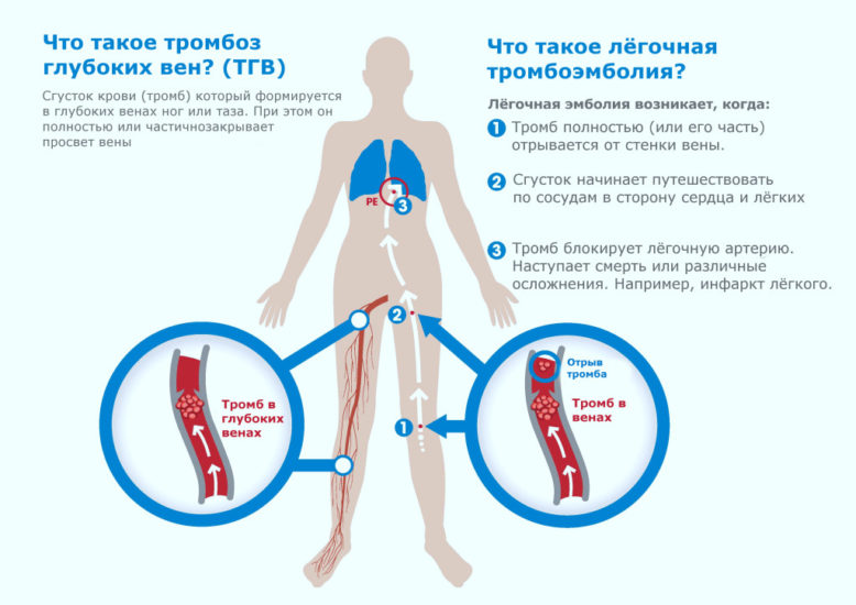 Как вовремя выявить мезентериальный тромбоз кишечника причины, симптомы и последствия
