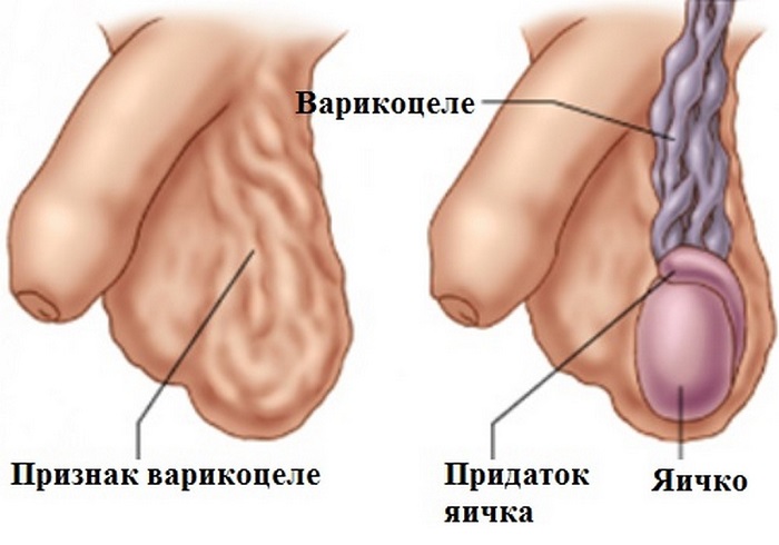 Как определить варикоцеле яичка