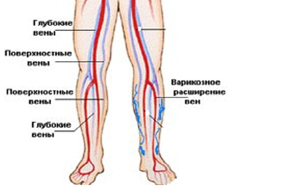 Тромбоз вен и артерий нижних конечностей фото симптомов, лечение и профилактика