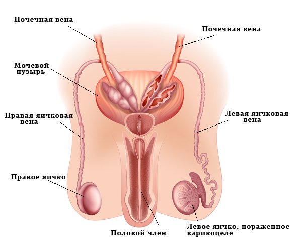 Как проводить медикаментозное лечение варикоцеле яичка у мужчин