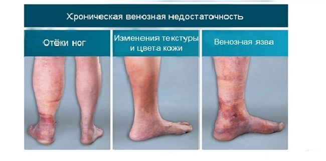 Лимфовенозная недостаточность ног