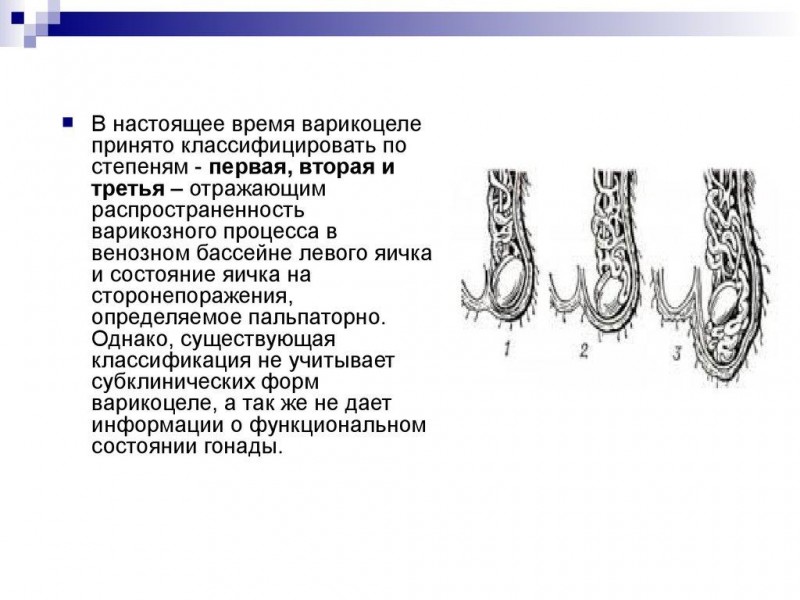 Как определить варикоцеле яичка