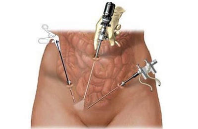 Виды операций варикоцеле яичка у мужчин