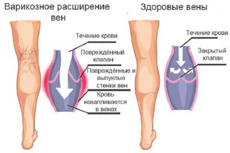 Как лечить варикоз на ногах у мужчин